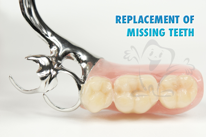 REPLACEMENT-OF-MISSING-TEETH