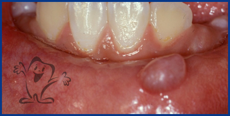Removal-of-local-lesionsexcisional-biopsy