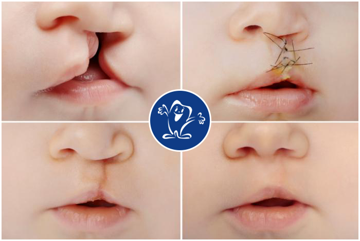 cleft-surgery